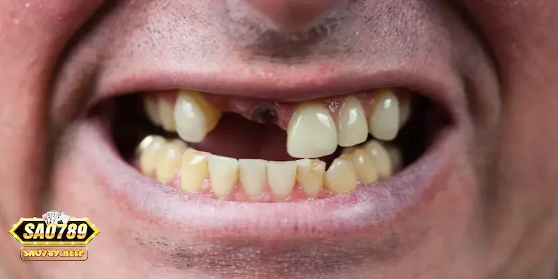 Các tình huống mơ thấy rụng răng và ý nghĩa sâu xa